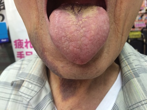 過敏性大腸炎に漢方薬？