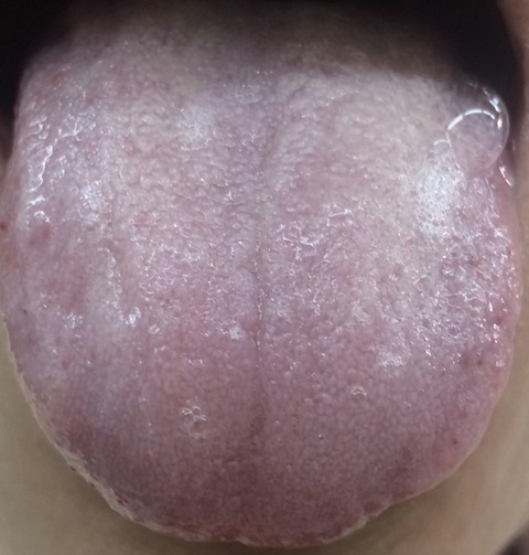 健康な時の舌