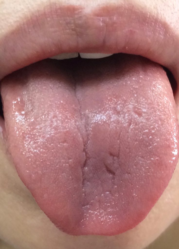 膠原病、シェーングレン症候群の舌　治療途中