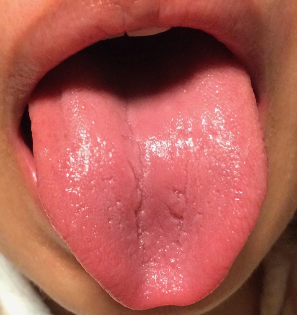 膠原病、シェーングレン症候群の舌　治療前