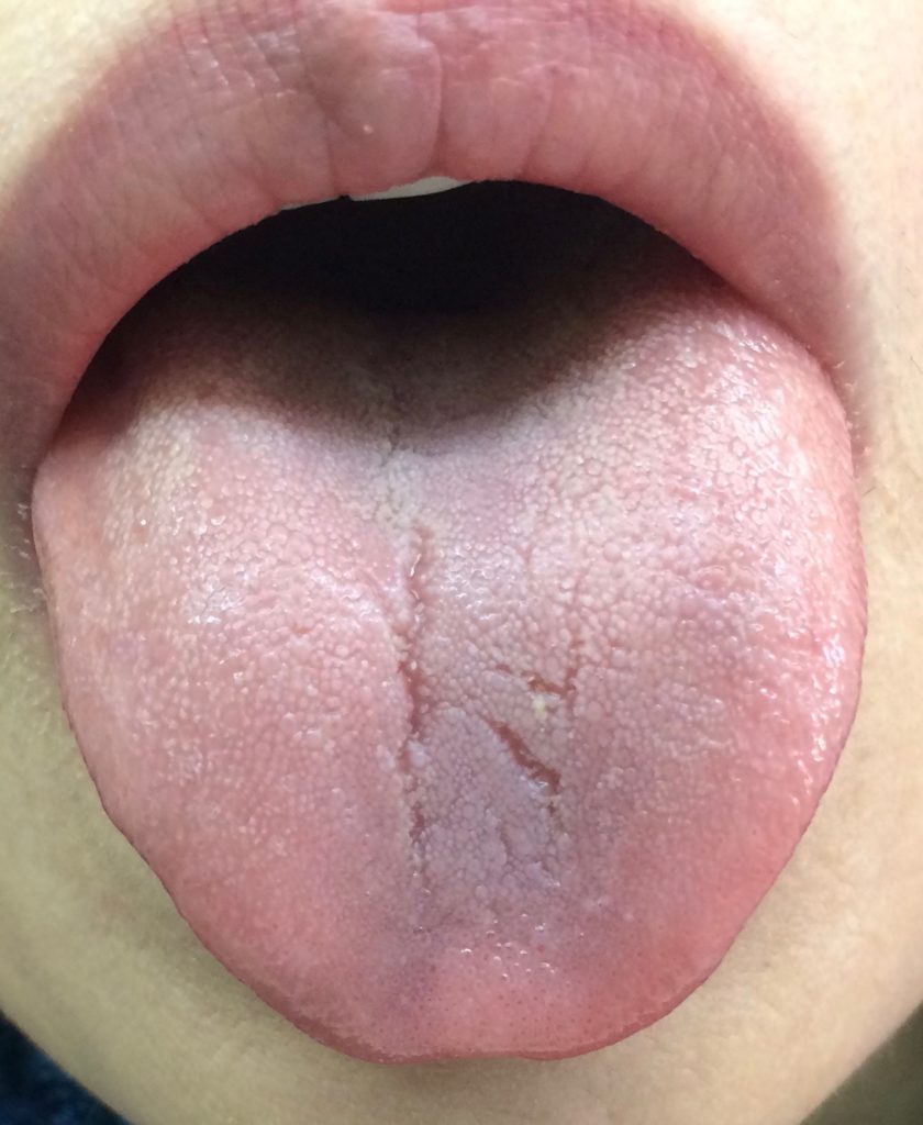 膠原病、シェーングレン症候群の舌　治療後